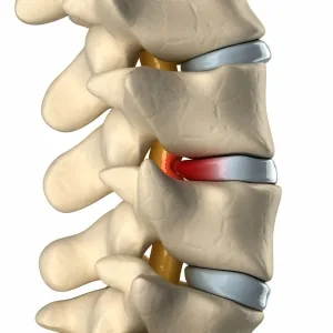 Illustration of a lumbar spine with a herniated disc highlighted